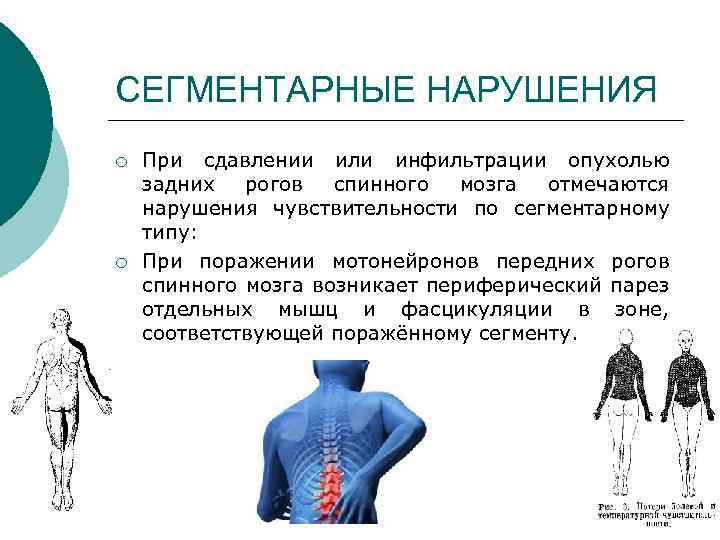 СЕГМЕНТАРНЫЕ НАРУШЕНИЯ ¡ ¡ При сдавлении или инфильтрации опухолью задних рогов спинного мозга отмечаются