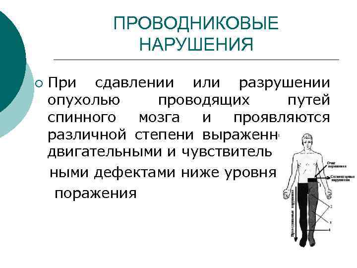 ПРОВОДНИКОВЫЕ НАРУШЕНИЯ При сдавлении или разрушении опухолью проводящих путей спинного мозга и проявляются различной
