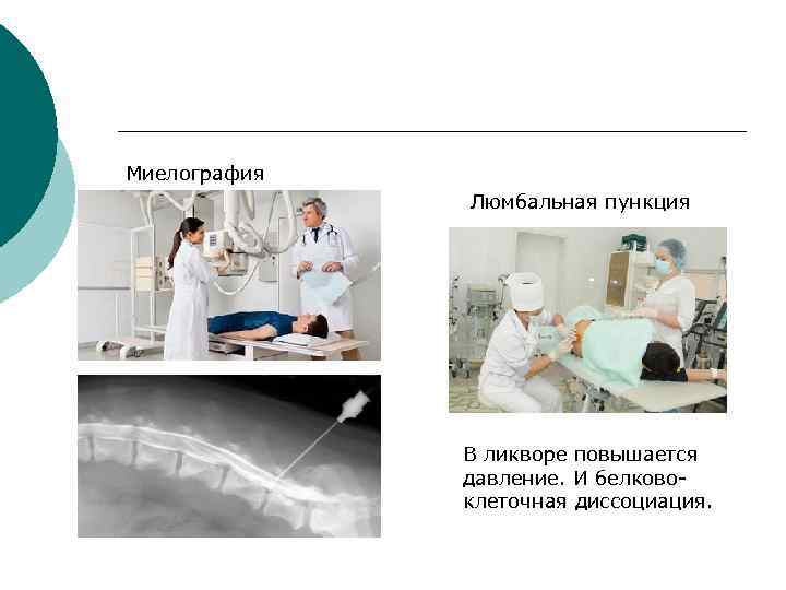 Миелография Люмбальная пункция В ликворе повышается давление. И белковоклеточная диссоциация. 