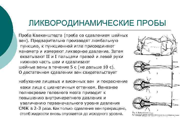 ЛИКВОРОДИНАМИЧЕСКИЕ ПРОБЫ Проба Квекенштедта (проба со сдавлением шейных вен). Предварительно производят люмбальную пункцию, к