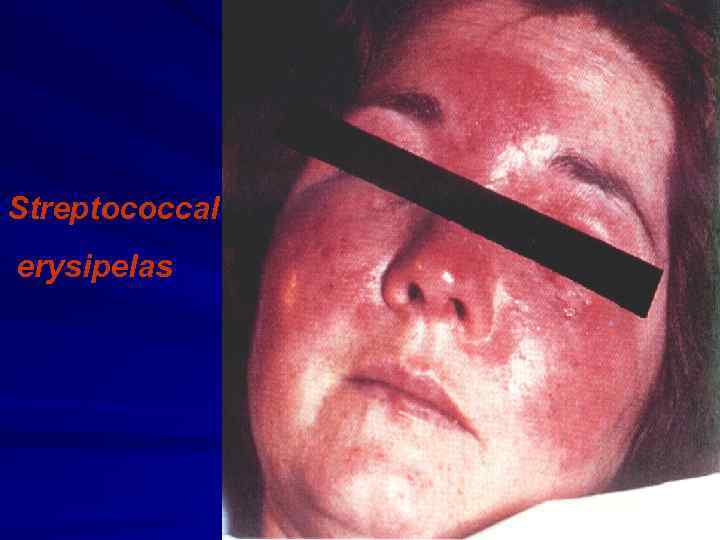 Streptococcal erysipelas 
