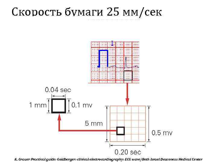Скорость бумаги 25 мм/сек K. Grauer Practical guide; Goldberger: clinical electrocardiography; ECG wave/Beth Israel