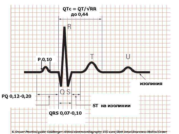 QTc = QT/√RR до 0, 44 Р 0, 10 изолиния PQ 0, 12 -0,
