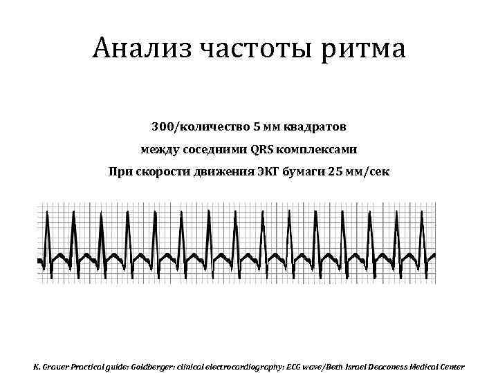Анализ частоты ритма 300/количество 5 мм квадратов между соседними QRS комплексами При скорости движения