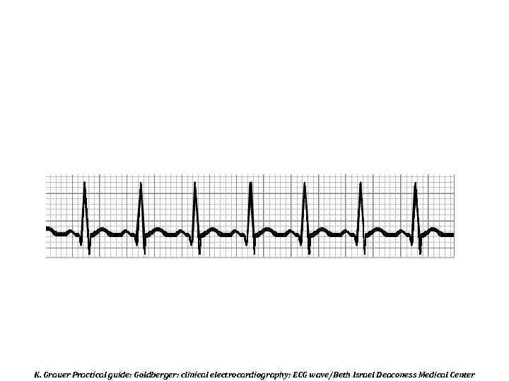 K. Grauer Practical guide; Goldberger: clinical electrocardiography; ECG wave/Beth Israel Deaconess Medical Center 