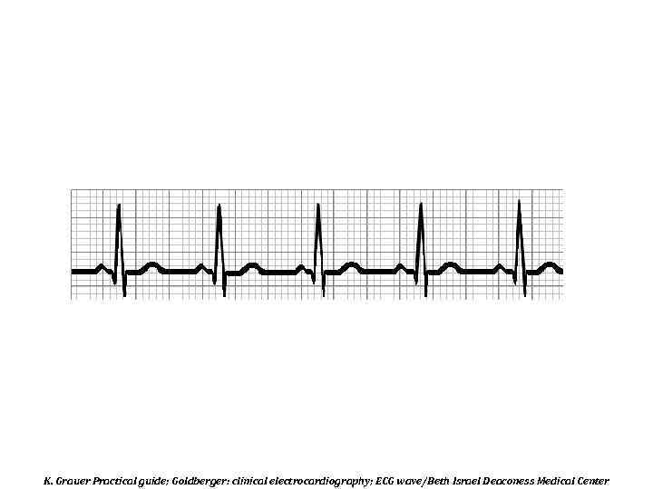 K. Grauer Practical guide; Goldberger: clinical electrocardiography; ECG wave/Beth Israel Deaconess Medical Center 