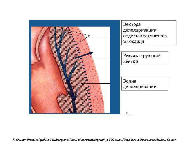 Вектора деполяризации отдельных участков миокарда Результирующий вектор Волна деполяризации K. Grauer Practical guide; Goldberger: