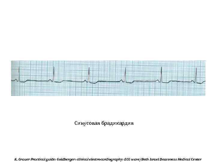 Синусовая брадикардия K. Grauer Practical guide; Goldberger: clinical electrocardiography; ECG wave/Beth Israel Deaconess Medical