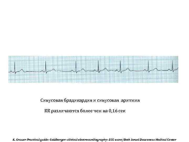 Синусовая брадикардия и синусовая аритмия RR различаются более чем на 0, 16 сек K.