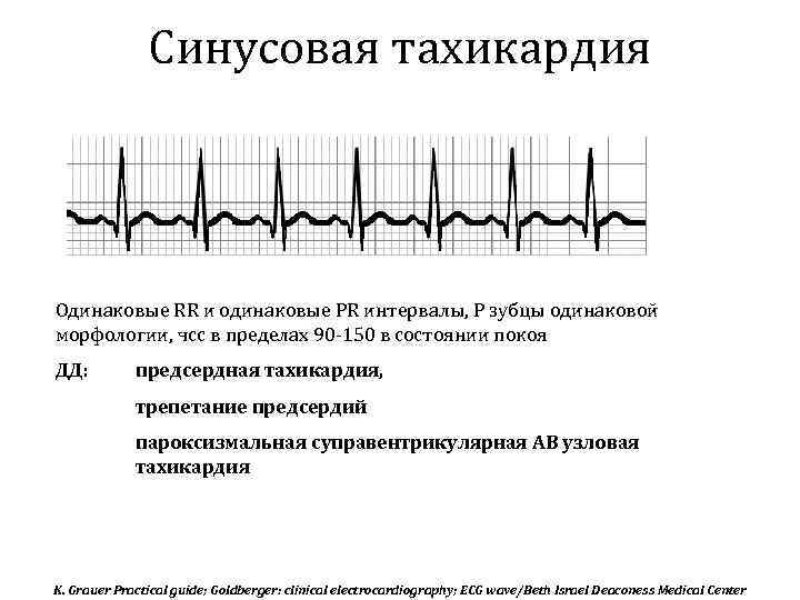 Что такое тахикардия