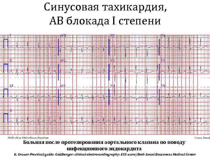 Синусовая тахикардия, АВ блокада I степени Больная после протезирования аортального клапана по поводу инфекционного