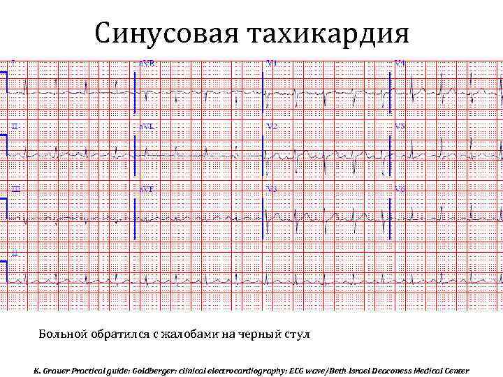 Синусовая тахикардия Больной обратился с жалобами на черный стул K. Grauer Practical guide; Goldberger: