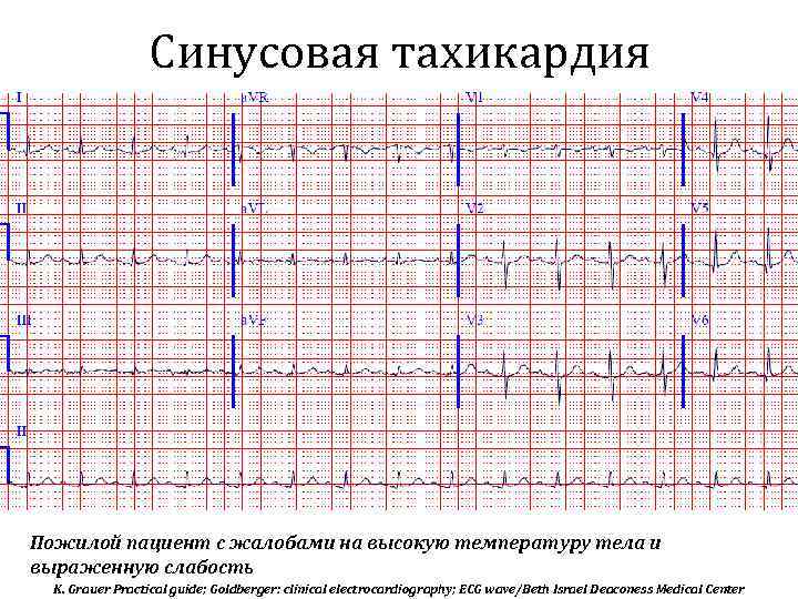 Синусовая тахикардия Пожилой пациент с жалобами на высокую температуру тела и выраженную слабость K.