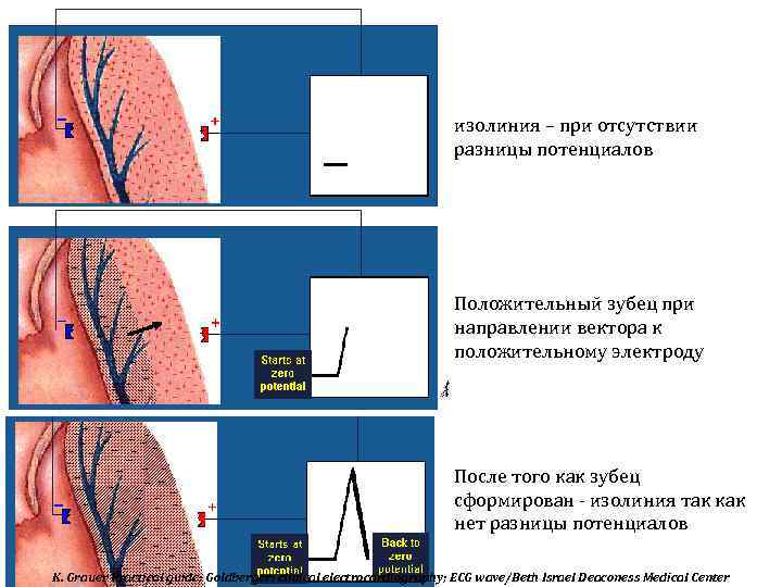 изолиния – при отсутствии разницы потенциалов Положительный зубец при направлении вектора к положительному электроду