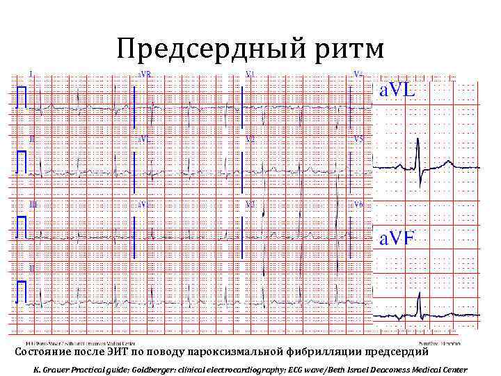 Предсердный ритм Состояние после ЭИТ по поводу пароксизмальной фибрилляции предсердий K. Grauer Practical guide;