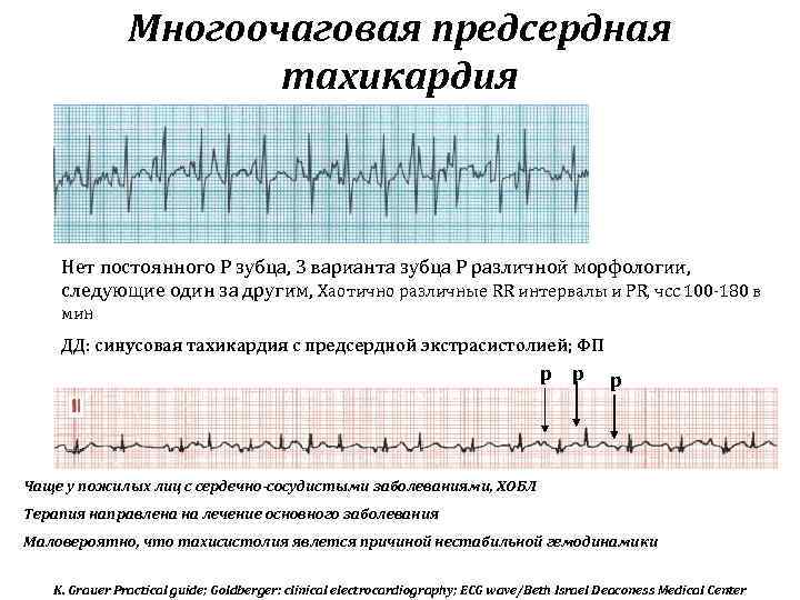 Многоочаговая предсердная тахикардия Нет постоянного Р зубца, 3 варианта зубца Р различной морфологии, следующие