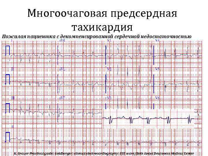Многоочаговая предсердная тахикардия Пожилая пациентка с декомпенсированной сердечной недостаточностью K. Grauer Practical guide; Goldberger:
