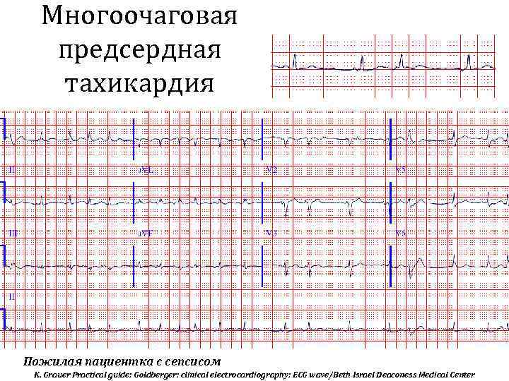 Многоочаговая предсердная тахикардия Пожилая пациентка с сепсисом K. Grauer Practical guide; Goldberger: clinical electrocardiography;