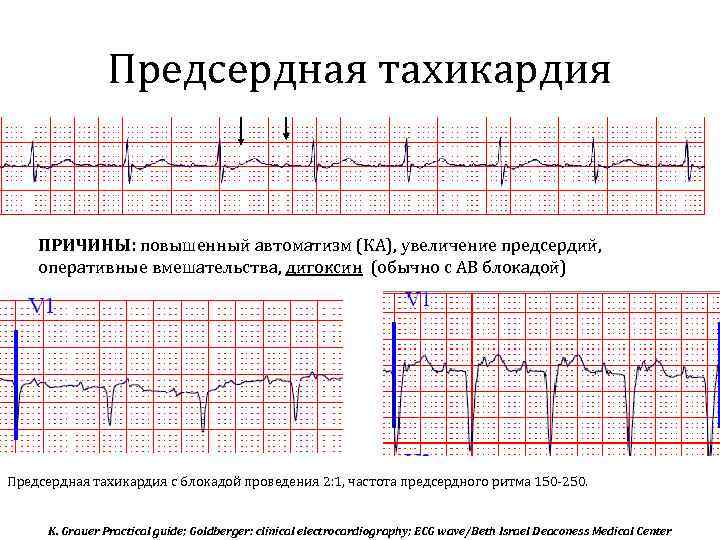 Предсердная тахикардия ПРИЧИНЫ: повышенный автоматизм (КА), увеличение предсердий, оперативные вмешательства, дигоксин (обычно с АВ