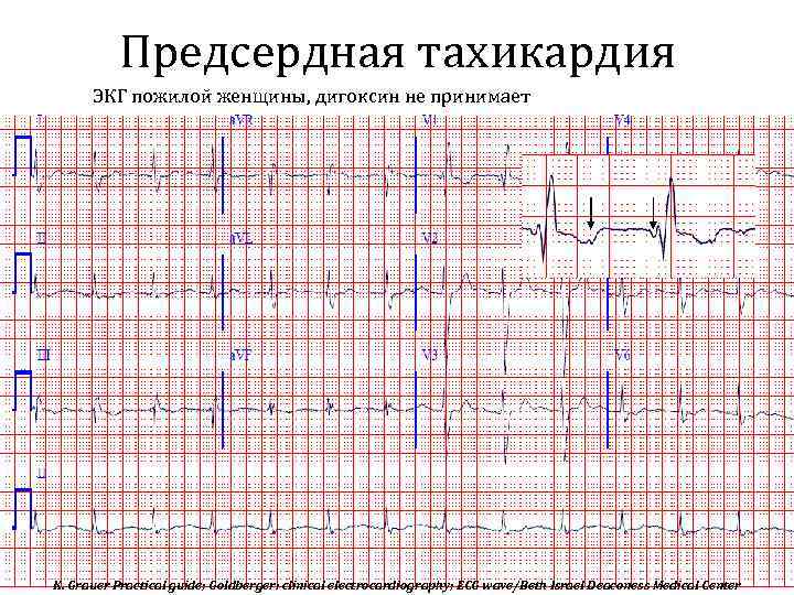 Предсердная тахикардия. Полифокусная предсердная тахикардия на ЭКГ. Многоочаговая предсердная тахикардия. Многофокусная предсердная тахикардия на ЭКГ. Нижнепредсердная тахикардия на ЭКГ.