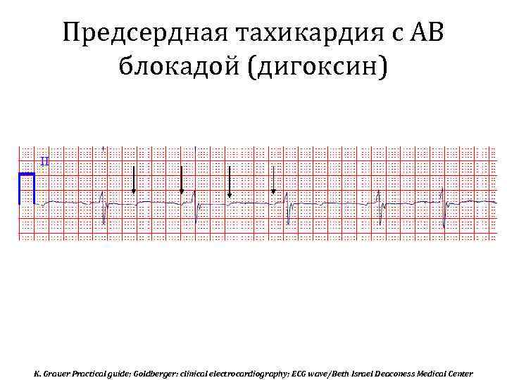 Предсердная тахикардия. Предсердная тахикардия с АВ блокадой 1 степени. Предсердная тахикардия с АВ блокадой 2:1. Многофокусная предсердная тахикардия на ЭКГ. Полифокусная предсердная тахикардия на ЭКГ.