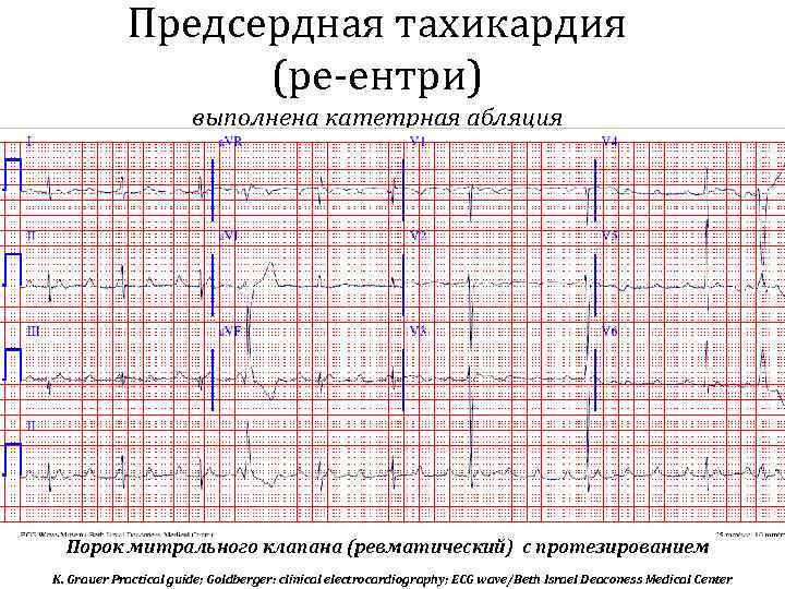 Предсердная тахикардия (ре-ентри) выполнена катетрная абляция Порок митрального клапана (ревматический) с протезированием K. Grauer
