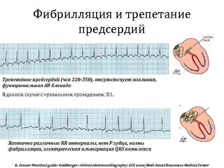 Фибрилляция и трепетание предсердий Трепетание предсердий (чсп 220 -350), отсутстсвует изолиния, функциональная АВ блокада