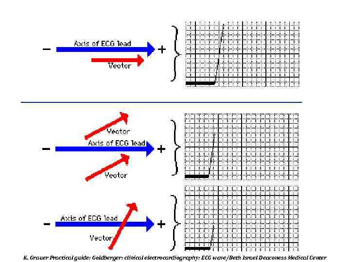 K. Grauer Practical guide; Goldberger: clinical electrocardiography; ECG wave/Beth Israel Deaconess Medical Center 
