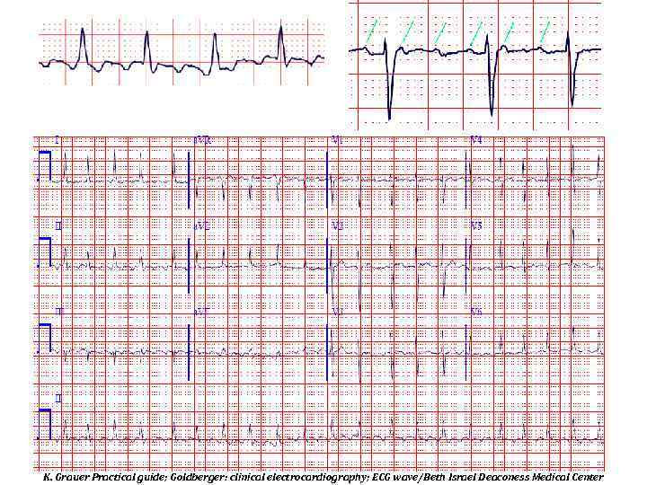 K. Grauer Practical guide; Goldberger: clinical electrocardiography; ECG wave/Beth Israel Deaconess Medical Center 