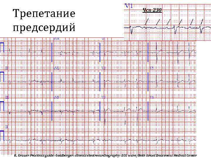 Трепетание предсердий Чсп 230 K. Grauer Practical guide; Goldberger: clinical electrocardiography; ECG wave/Beth Israel