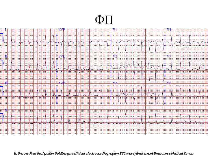 ФП K. Grauer Practical guide; Goldberger: clinical electrocardiography; ECG wave/Beth Israel Deaconess Medical Center