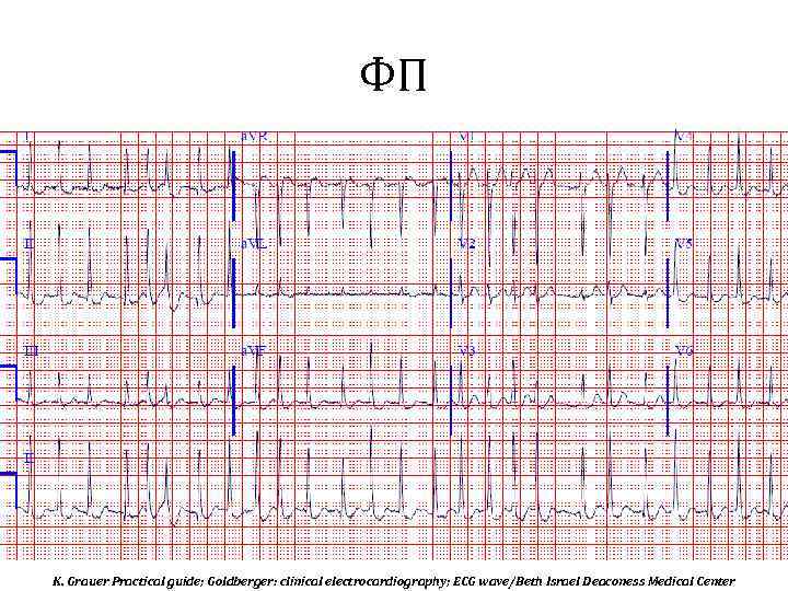 ФП K. Grauer Practical guide; Goldberger: clinical electrocardiography; ECG wave/Beth Israel Deaconess Medical Center