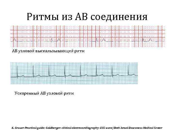 Ритмы из АВ соединения АВ узловой выскальзывающий ритм Ускоренный АВ узловой ритм K. Grauer