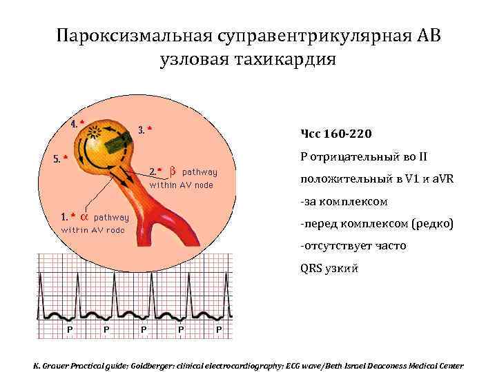 Пароксизмальная суправентрикулярная АВ узловая тахикардия Чсс 160 -220 Р отрицательный во II положительный в
