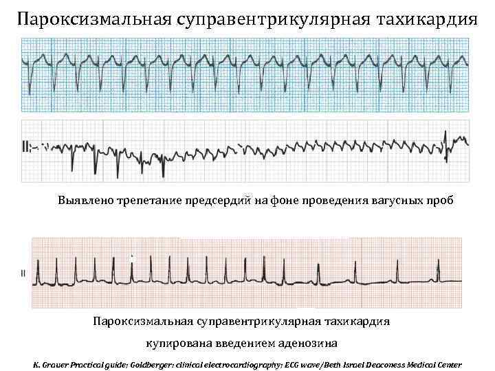 Пароксизмальная суправентрикулярная тахикардия Выявлено трепетание предсердий на фоне проведения вагусных проб Пароксизмальная суправентрикулярная тахикардия