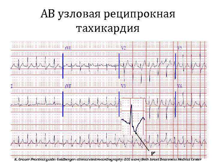 АВ узловая реципрокная тахикардия Р’ K. Grauer Practical guide; Goldberger: clinical electrocardiography; ECG wave/Beth