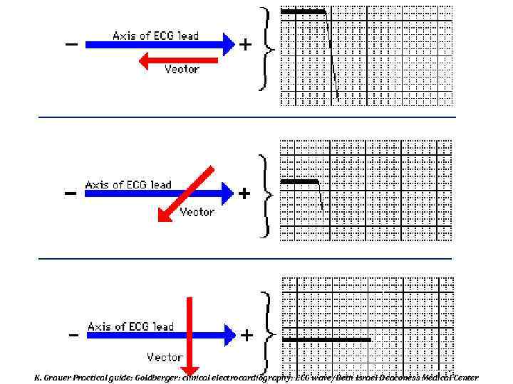 K. Grauer Practical guide; Goldberger: clinical electrocardiography; ECG wave/Beth Israel Deaconess Medical Center 