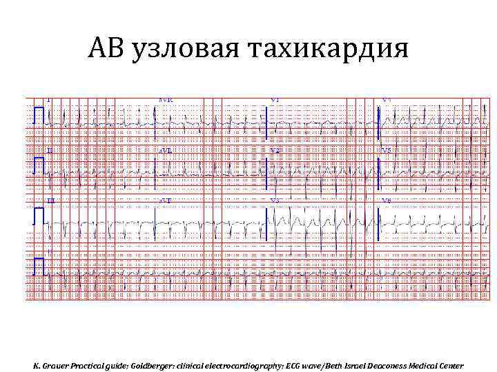 АВ узловая тахикардия K. Grauer Practical guide; Goldberger: clinical electrocardiography; ECG wave/Beth Israel Deaconess