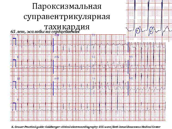 Пароксизмальная суправентрикулярная тахикардия 65 лет, жалобы на сердцебиения K. Grauer Practical guide; Goldberger: clinical