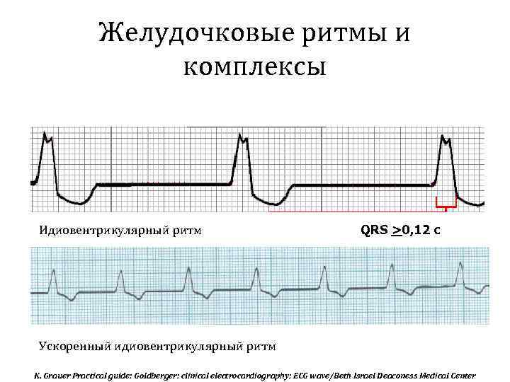 Желудочковые ритмы и комплексы Идиовентрикулярный ритм QRS >0, 12 с Ускоренный идиовентрикулярный ритм K.