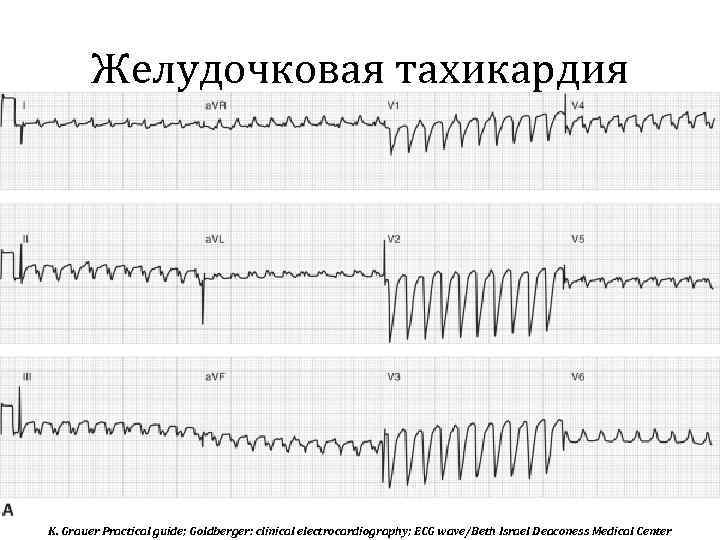 Желудочковая тахикардия K. Grauer Practical guide; Goldberger: clinical electrocardiography; ECG wave/Beth Israel Deaconess Medical