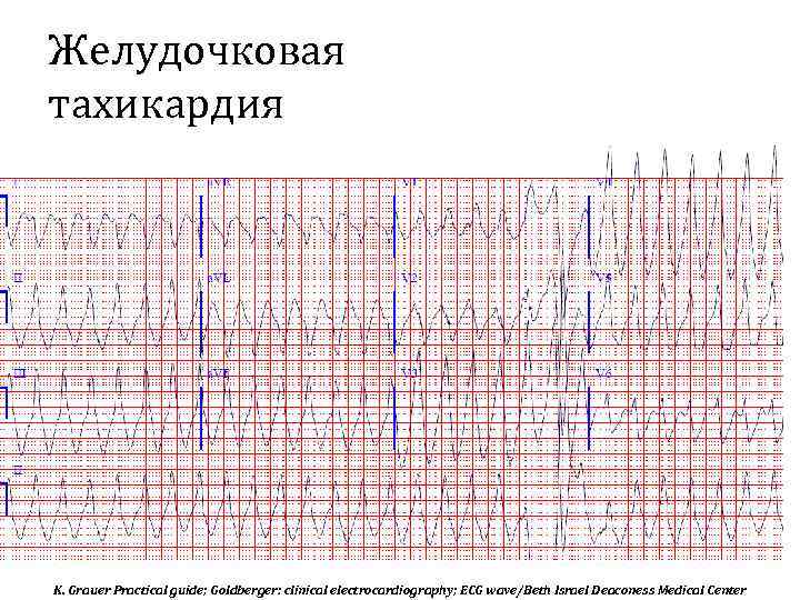 Желудочковая тахикардия K. Grauer Practical guide; Goldberger: clinical electrocardiography; ECG wave/Beth Israel Deaconess Medical