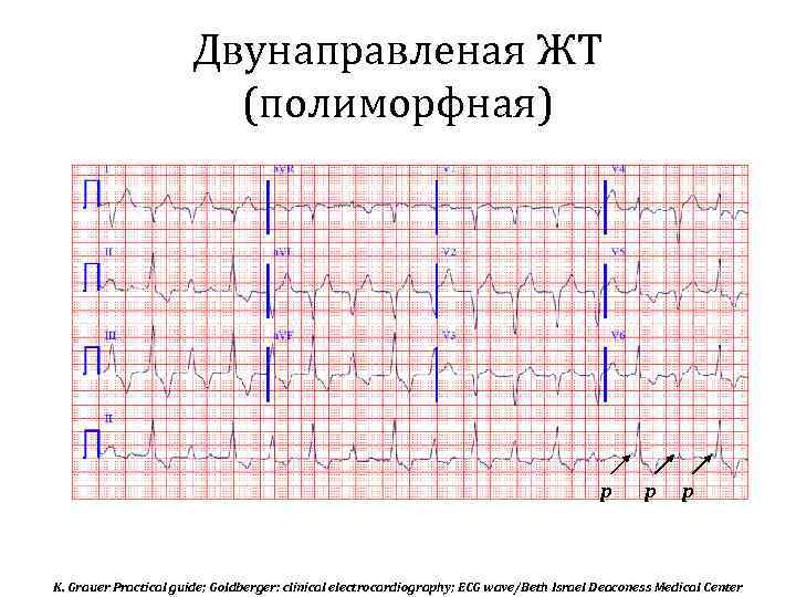Двунаправленая ЖТ (полиморфная) р р р K. Grauer Practical guide; Goldberger: clinical electrocardiography; ECG