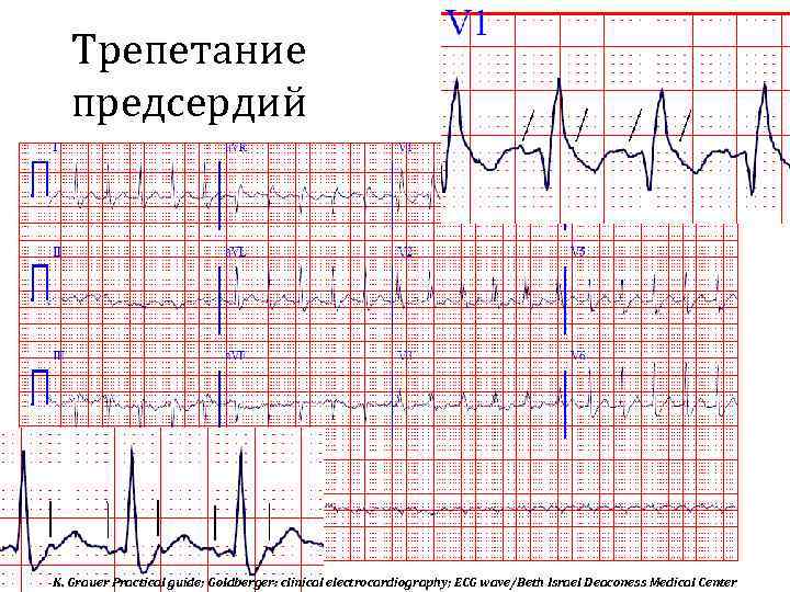 Трепетание предсердий K. Grauer Practical guide; Goldberger: clinical electrocardiography; ECG wave/Beth Israel Deaconess Medical