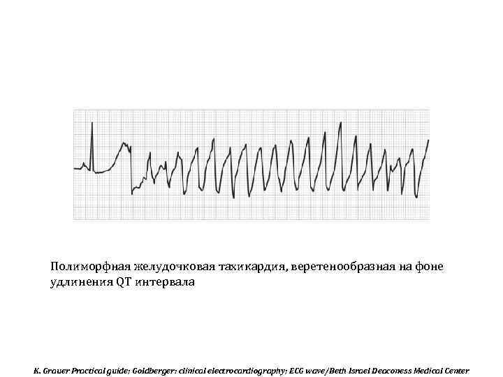 Полиморфная желудочковая тахикардия, веретенообразная на фоне удлинения QT интервала K. Grauer Practical guide; Goldberger:
