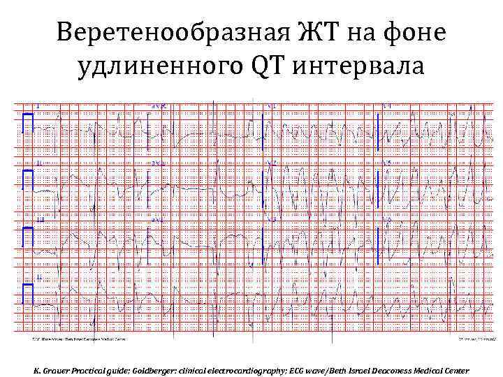 Веретенообразная ЖТ на фоне удлиненного QT интервала K. Grauer Practical guide; Goldberger: clinical electrocardiography;
