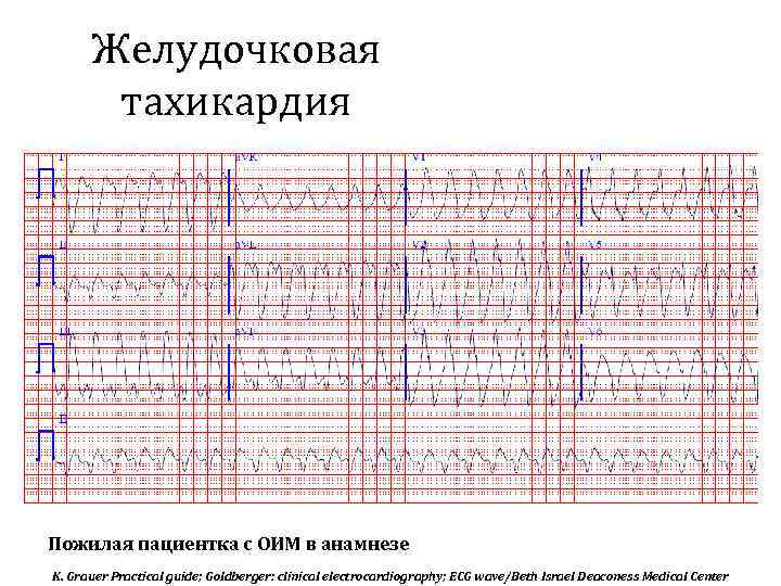 Желудочковая тахикардия Пожилая пациентка с ОИМ в анамнезе K. Grauer Practical guide; Goldberger: clinical