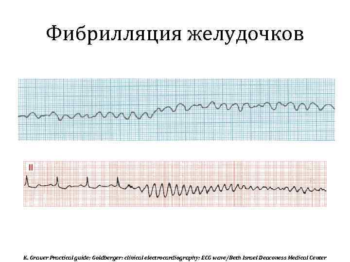 Фибрилляция желудочков K. Grauer Practical guide; Goldberger: clinical electrocardiography; ECG wave/Beth Israel Deaconess Medical