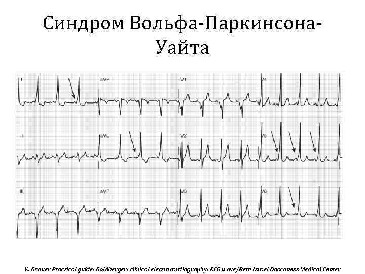 Синдром Вольфа-Паркинсона. Уайта K. Grauer Practical guide; Goldberger: clinical electrocardiography; ECG wave/Beth Israel Deaconess