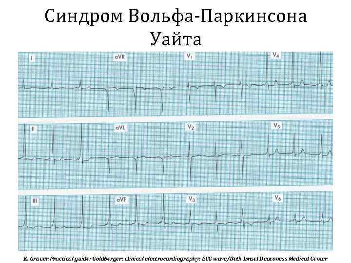 Синдром Вольфа-Паркинсона Уайта K. Grauer Practical guide; Goldberger: clinical electrocardiography; ECG wave/Beth Israel Deaconess